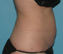 Before SmartLipo™ by Dr. Normand Miller, Salem, NH and Nashua, NH