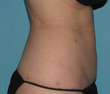 After SmartLipo™ by Dr. Normand Miller, Salem, NH and Nashua, NH