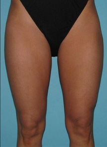 After SmartLipo™ by Dr. Normand Miller, Salem, NH and Nashua, NH