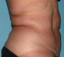 After SmartLipo™ by Dr. Normand Miller, Salem, NH and Nashua, NH