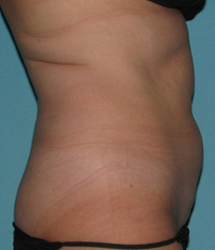 Before SmartLipo™ by Dr. Normand Miller, Salem, NH and Nashua, NH