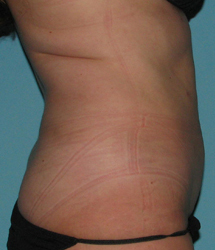 After SmartLipo™ by Dr. Normand Miller, Salem, NH and Nashua, NH