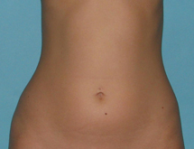 Before SmartLipo™ by Dr. Normand Miller, Salem, NH and Nashua, NH