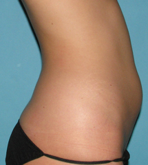 Before SmartLipo™ by Dr. Normand Miller, Salem, NH and Nashua, NH