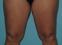 Before SmartLipo™ by Dr. Normand Miller, Salem, NH and Nashua, NH