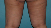 After SmartLipo™ by Dr. Normand Miller, Salem, NH and Nashua, NH