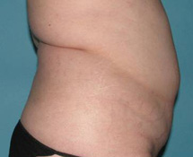 Before SmartLipo™ by Dr. Normand Miller, Salem, NH and Nashua, NH