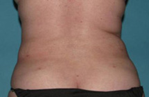 After SmartLipo™ by Dr. Normand Miller, Salem, NH and Nashua, NH