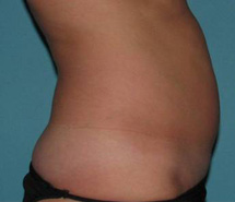 Before SmartLipo™ by Dr. Normand Miller, Salem, NH and Nashua, NH