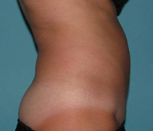 After SmartLipo™ by Dr. Normand Miller, Salem, NH and Nashua, NH