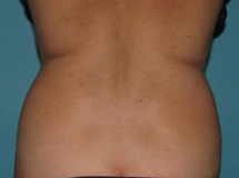 Before SmartLipo™ by Dr. Normand Miller, Salem, NH and Nashua, NH