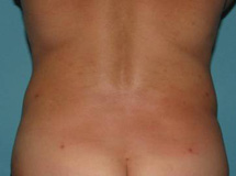 After SmartLipo™ by Dr. Normand Miller, Salem, NH and Nashua, NH