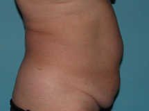 Before SmartLipo™ by Dr. Normand Miller, Salem, NH and Nashua, NH