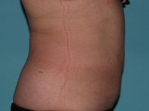 After SmartLipo™ by Dr. Normand Miller, Salem, NH and Nashua, NH