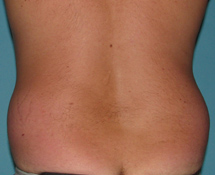 Before SmartLipo™ by Dr. Normand Miller, Salem, NH and Nashua, NH