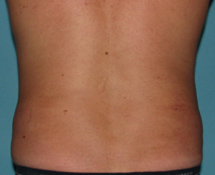 After SmartLipo™ by Dr. Normand Miller, Salem, NH and Nashua, NH