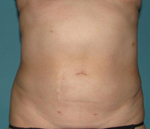 After SmartLipo™ by Dr. Normand Miller, Salem, NH and Nashua, NH