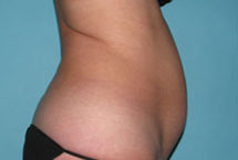 Before SmartLipo™ by Dr. Normand Miller, Salem, NH and Nashua, NH