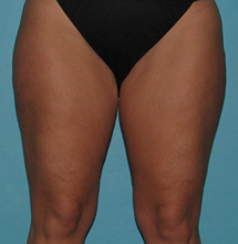 Before SmartLipo™ by Dr. Normand Miller, Salem, NH and Nashua, NH