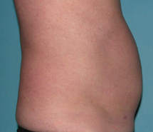 Before SmartLipo™ by Dr. Normand Miller, Salem, NH and Nashua, NH