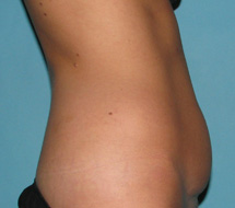 Before SmartLipo™ by Dr. Normand Miller, Salem, NH and Nashua, NH