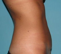 After SmartLipo™ by Dr. Normand Miller, Salem, NH and Nashua, NH