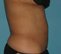 After SmartLipo™ by Dr. Normand Miller, Salem, NH and Nashua, NH