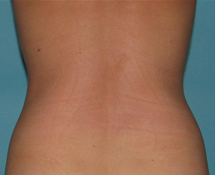 Before SmartLipo™ by Dr. Normand Miller, Salem, NH and Nashua, NH