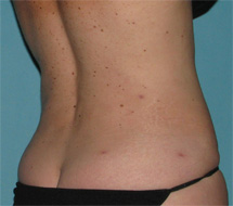 After SmartLipo™ by Dr. Normand Miller, Salem, NH and Nashua, NH