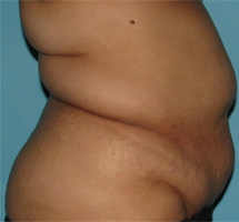 Before SmartLipo™ by Dr. Normand Miller, Salem, NH and Nashua, NH