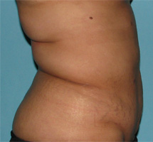 After SmartLipo™ by Dr. Normand Miller, Salem, NH and Nashua, NH