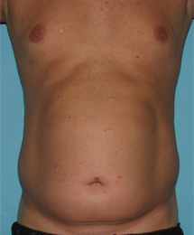 Before SmartLipo™ by Dr. Normand Miller, Salem, NH and Nashua, NH