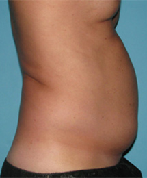 Before SmartLipo™ by Dr. Normand Miller, Salem, NH and Nashua, NH