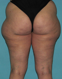 Before SmartLipo™ by Dr. Normand Miller, Salem, NH and Nashua, NH