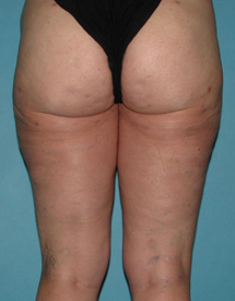 After SmartLipo™ by Dr. Normand Miller, Salem, NH and Nashua, NH