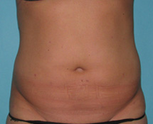 After SmartLipo™ by Dr. Normand Miller, Salem, NH and Nashua, NH