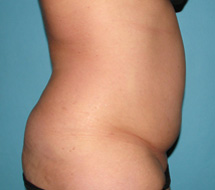 Before SmartLipo™ by Dr. Normand Miller, Salem, NH and Nashua, NH