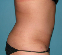 After SmartLipo™ by Dr. Normand Miller, Salem, NH and Nashua, NH