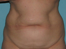 Before SmartLipo™ by Dr. Normand Miller, Salem, NH and Nashua, NH