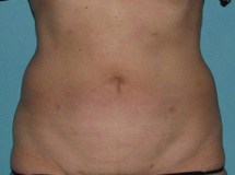 After SmartLipo™ by Dr. Normand Miller, Salem, NH and Nashua, NH