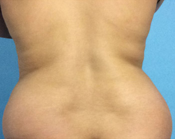 Before SmartLipo™ by Dr. Normand Miller, Salem, NH and Nashua, NH