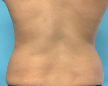 After SmartLipo™ by Dr. Normand Miller, Salem, NH and Nashua, NH