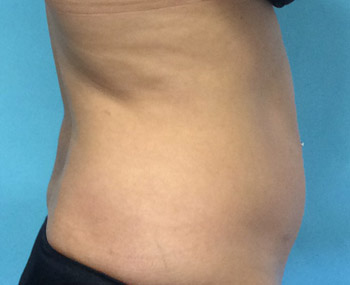 After SmartLipo™ by Dr. Normand Miller, Salem, NH and Nashua, NH