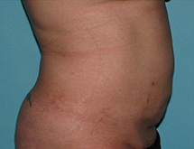 After SmartLipo™ by Dr. Normand Miller, Salem, NH and Nashua, NH