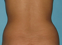 Before SmartLipo™ by Dr. Normand Miller, Salem, NH and Nashua, NH