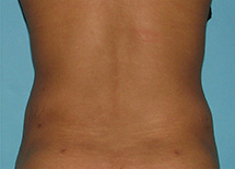 After SmartLipo™ by Dr. Normand Miller, Salem, NH and Nashua, NH