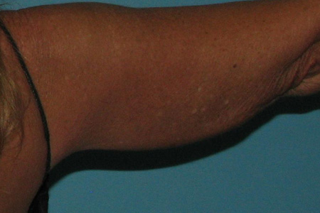 After SmartLipo™ by Dr. Normand Miller, Salem, NH and Nashua, NH